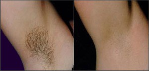 before and after images of an armpit before and after laser hair removal