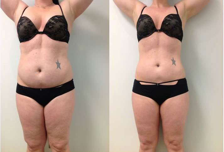 Two images showing a woman's body, excluding the head and feet, before and after a body contouring procedure, highlighting a more defined waistline and smoother contours throughout.