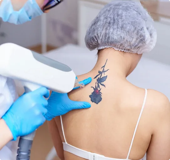 Tattoo Removal