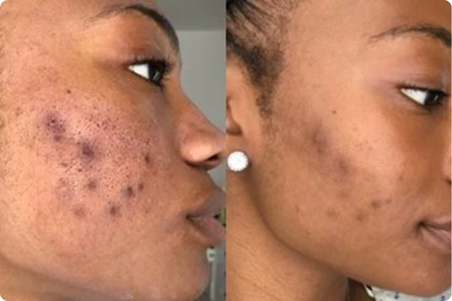 Before and After Results