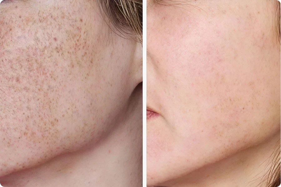 Before and After Results
