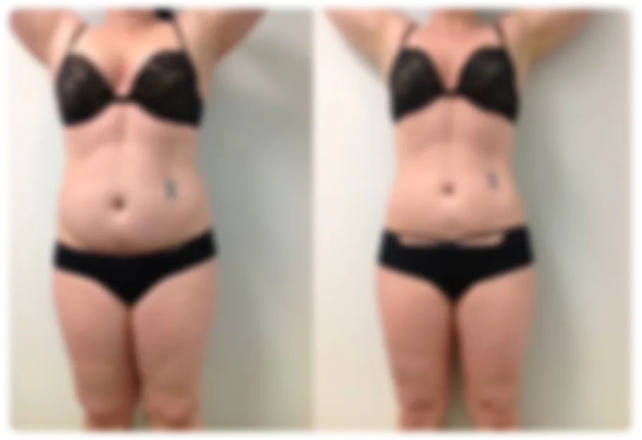 Before and After Results