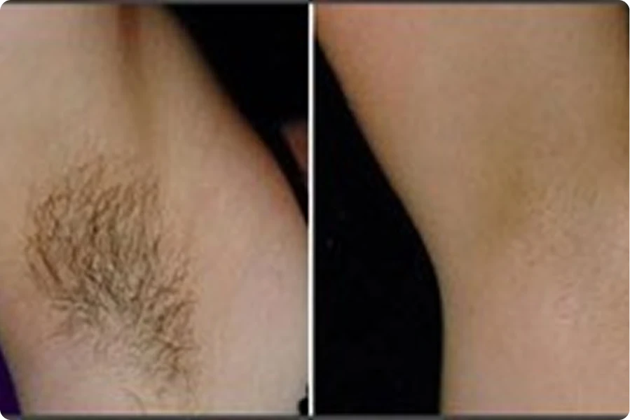 Before and After Results