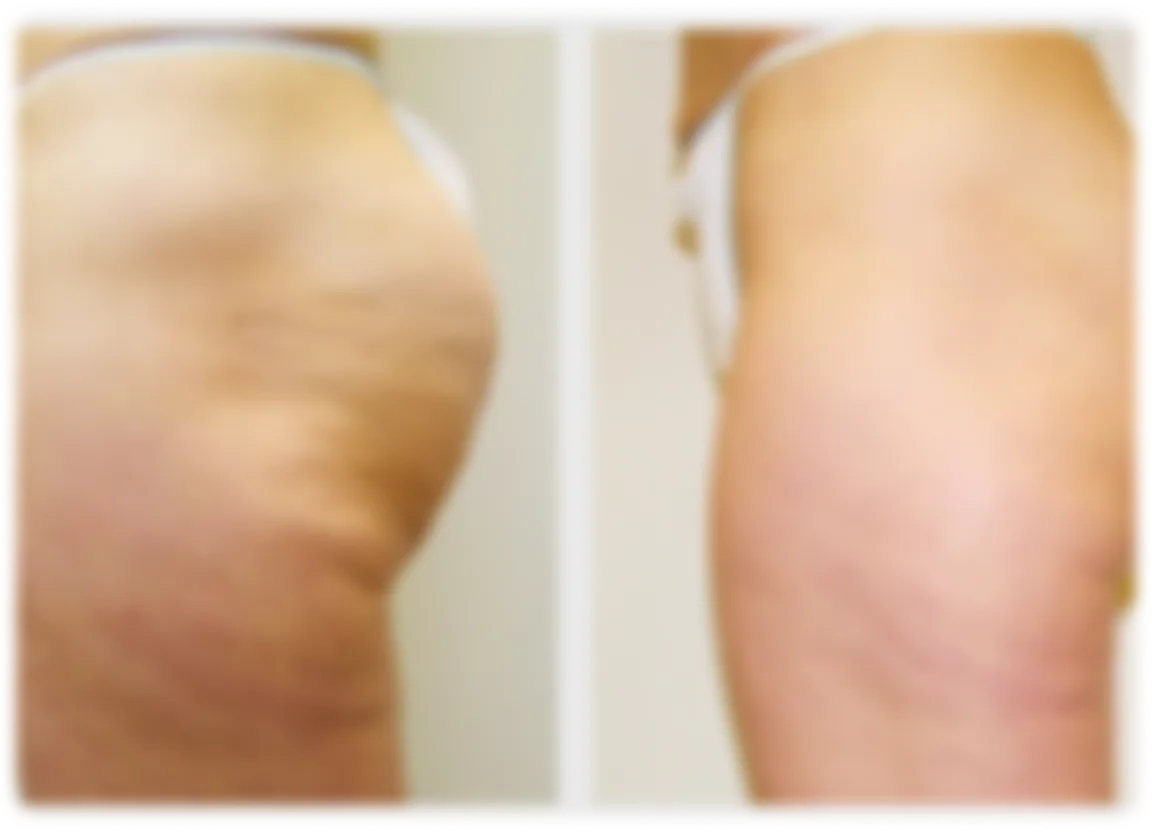 BioNexis Sculpting before and after