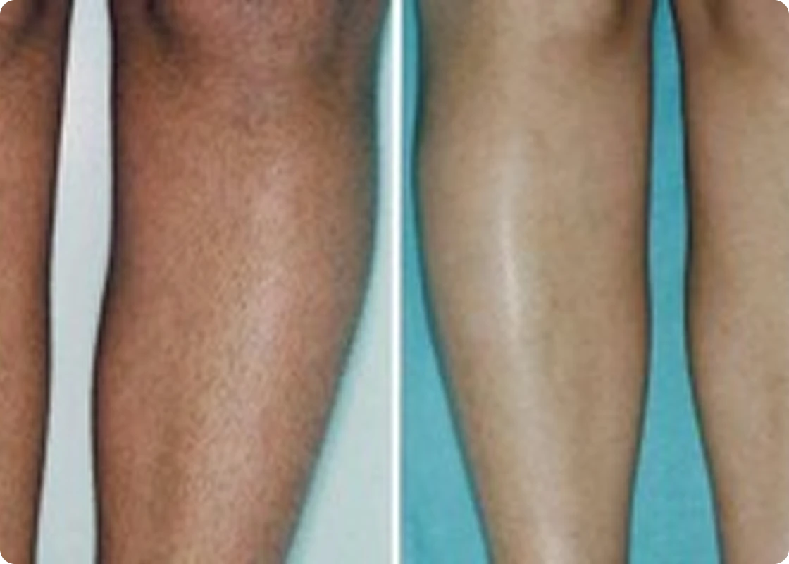 Laser Hair Removal before and after