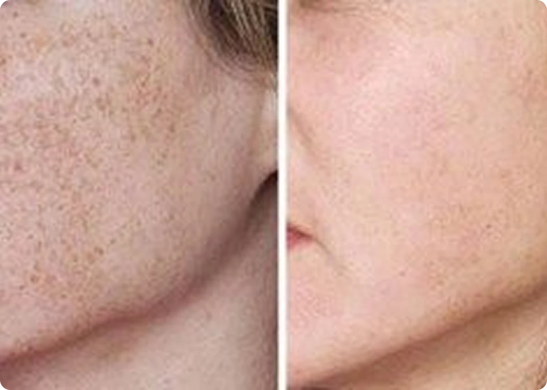 IPL Photofacial before and after
