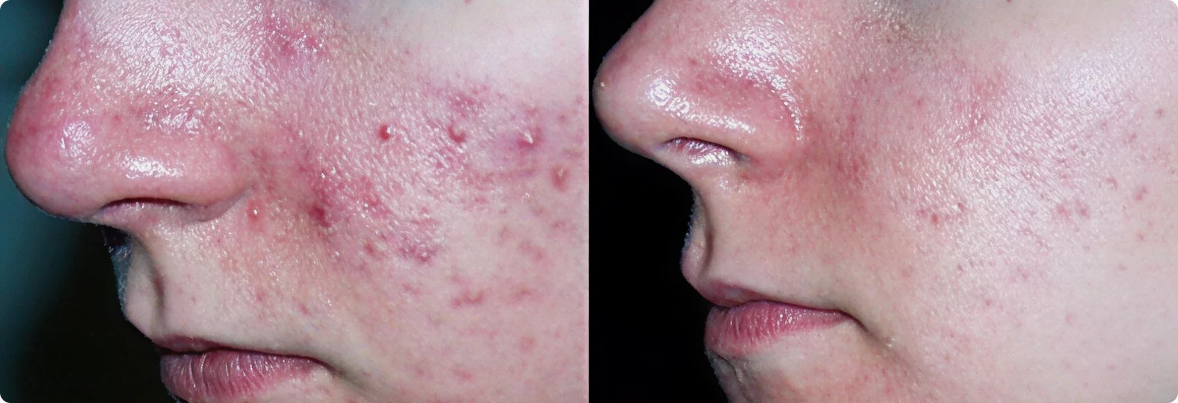 IPL Acne Treatment before and after