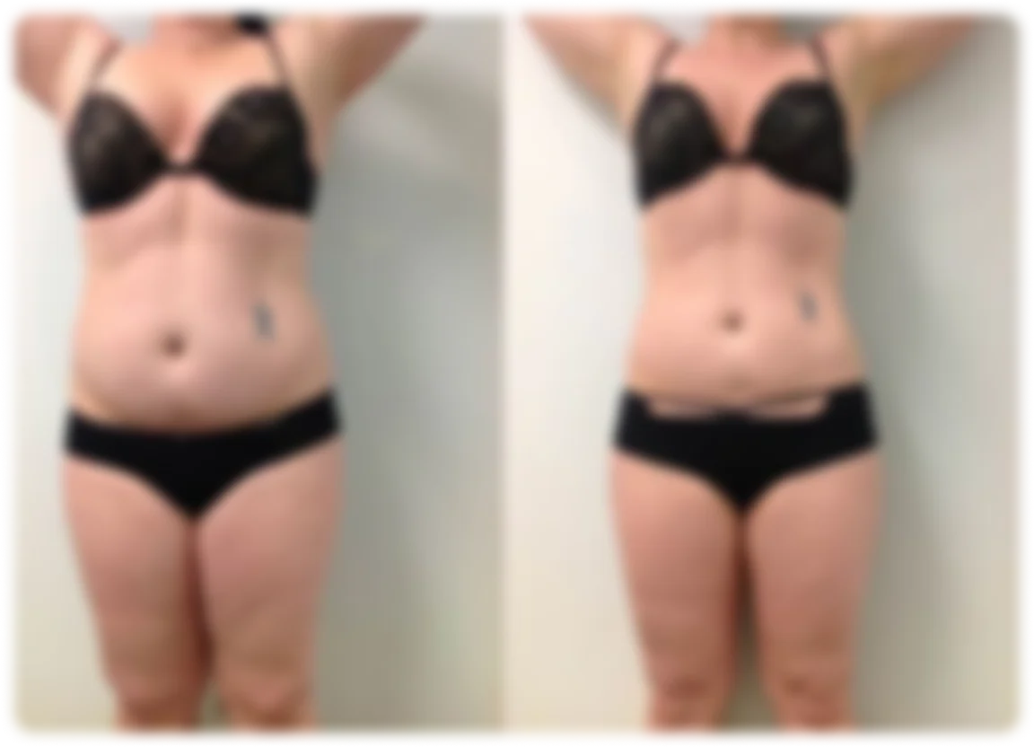 EmSlim NEO before and after